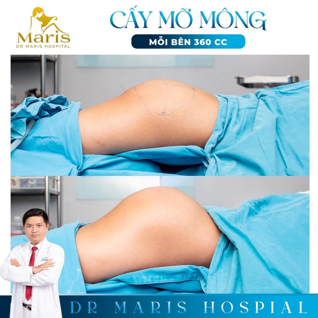 Autologous Fat Transfer & Sculpting